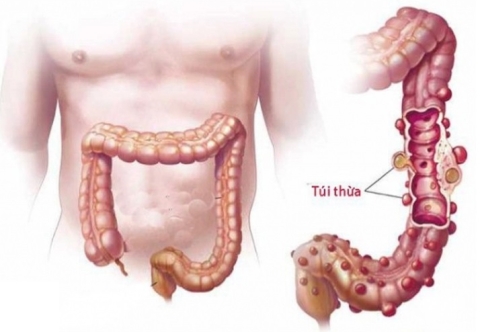 Khi nào bệnh túi thừa đại tràng cần được phẫu thuật?